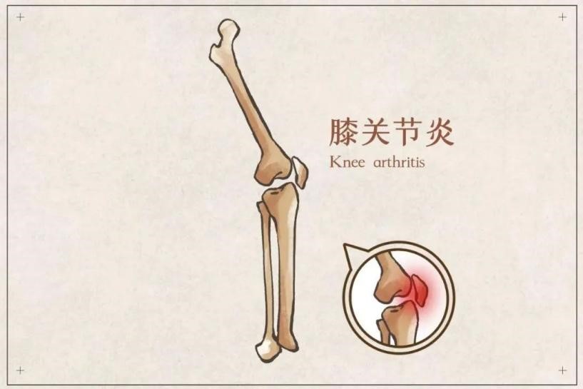 小小针刀胜过关节良药